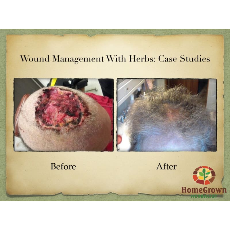 Herbal Wound Management Iii: Case Studies - Learning Modules Homegrown Herbalist